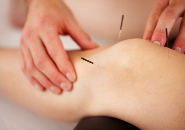 dry needling near me